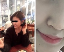 코성형 너무 만족합니다♡