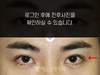 매몰법 쌍꺼풀수술
