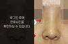 매부리코성형