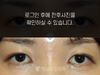 앞트임