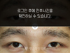 절개법 쌍꺼풀수술