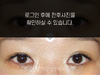 앞트임