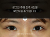 매몰법 쌍꺼풀수술