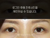매몰법 쌍꺼풀수술