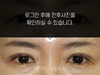 매몰법 쌍꺼풀수술