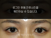 매몰법 쌍꺼풀수술