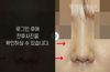 코재수술(코 끝 찝힘)