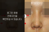 매부리코성형