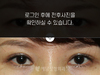 절개법 쌍꺼풀수술