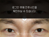 절개법 쌍꺼풀수술