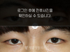 앞트임