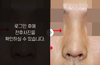 낮은코성형