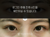 매몰법 쌍꺼풀수술