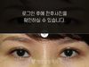 눈재수술