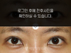 눈재수술