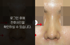 낮은코성형