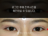 매몰법 쌍꺼풀수술