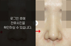 복코성형