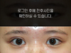 절개법 쌍꺼풀수술