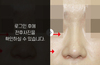 낮은코성형