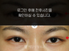 매몰법 쌍꺼풀수술