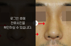 매부리코성형