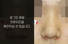 복코성형