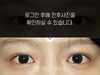 매몰법 쌍꺼풀수술