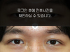 절개법 쌍꺼풀수술
