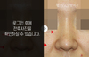 화살코성형
