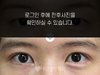 부분절개 쌍꺼풀수술