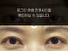 눈재수술