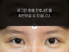 절개법 쌍꺼풀수술+앞트임