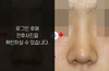 낮은코성형