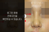 낮은코성형