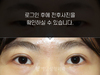 절개법 쌍꺼풀수술+앞트임