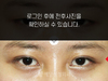 매몰법 쌍꺼풀수술