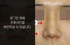 매부리코성형