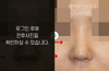 짧은코성형