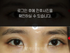 매몰법 쌍꺼풀수술