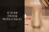휜코성형