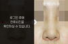 휜코성형