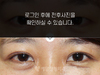 절개법 쌍꺼풀수술