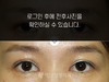눈재수술