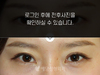 절개법 쌍꺼풀수술