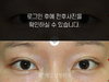 매몰법 쌍꺼풀수술