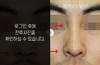 낮은코성형