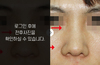 낮은코성형