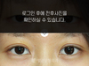부분절개법 쌍꺼풀수술