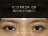 매몰법 쌍꺼풀수술